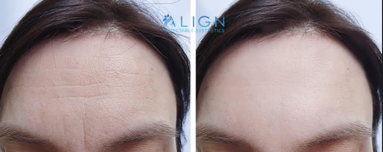 how-many-botox-units-align-injectable-aesthetics