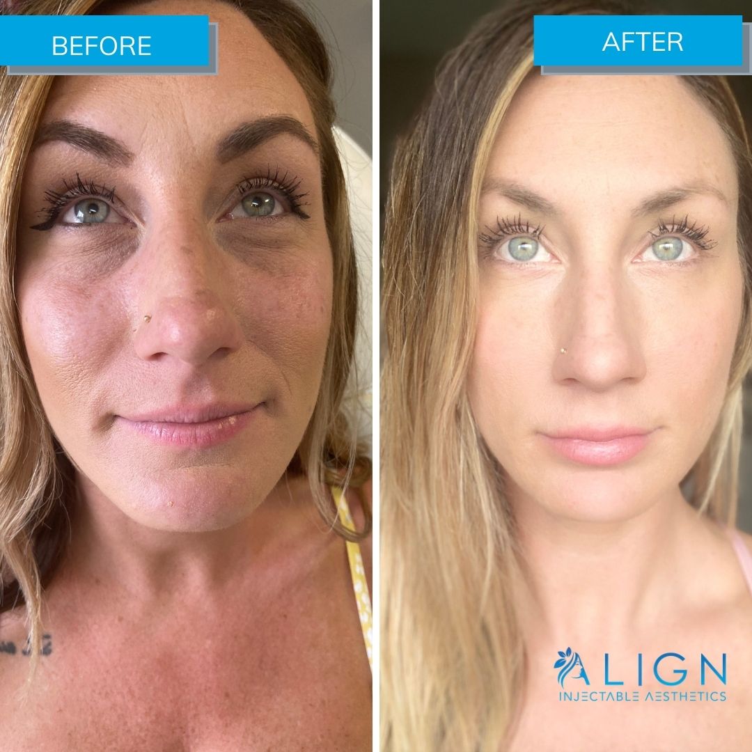 Before and after photo of Align Injectable client getting under eye filler to improve eye bags