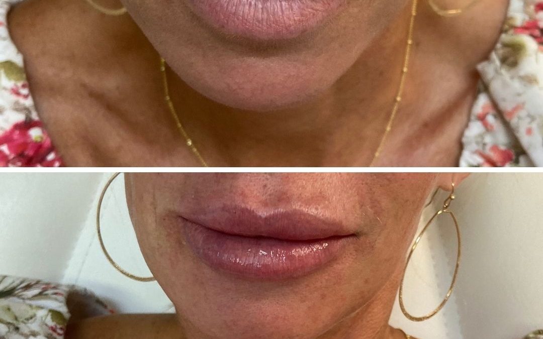 Jennifer P Before And After Lip Injections Align Injectable Aesthetics