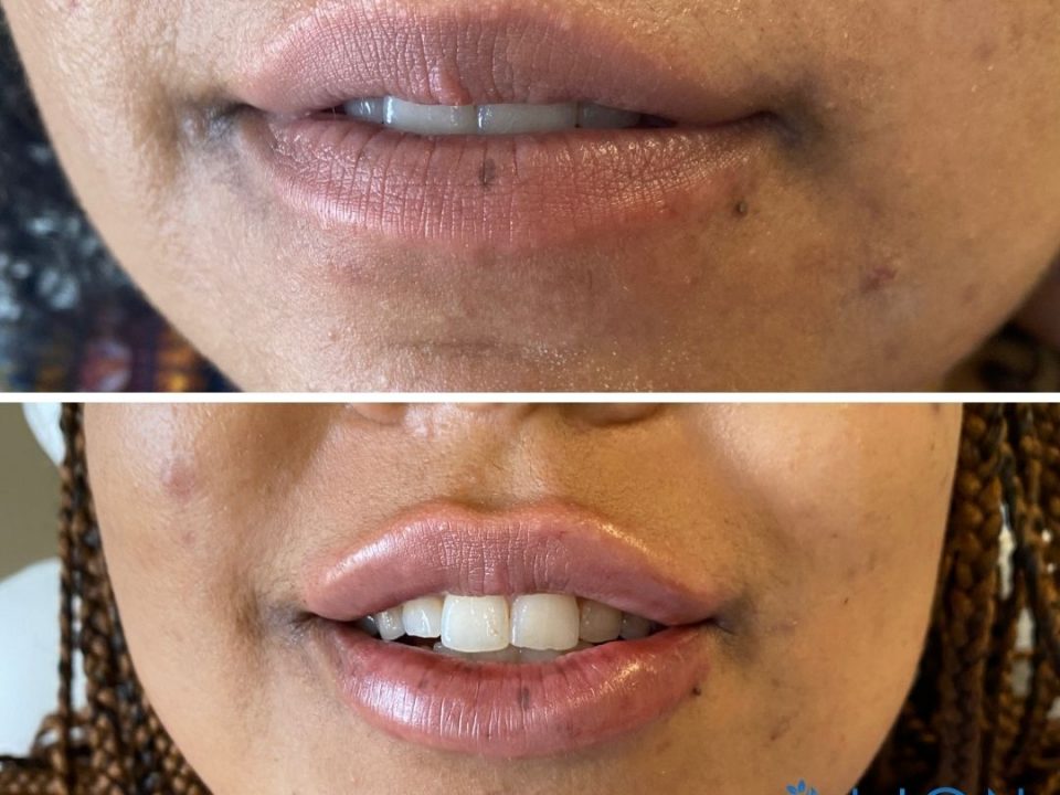 Lacy E Before And After Lip Injections Align Injectable Aesthetics