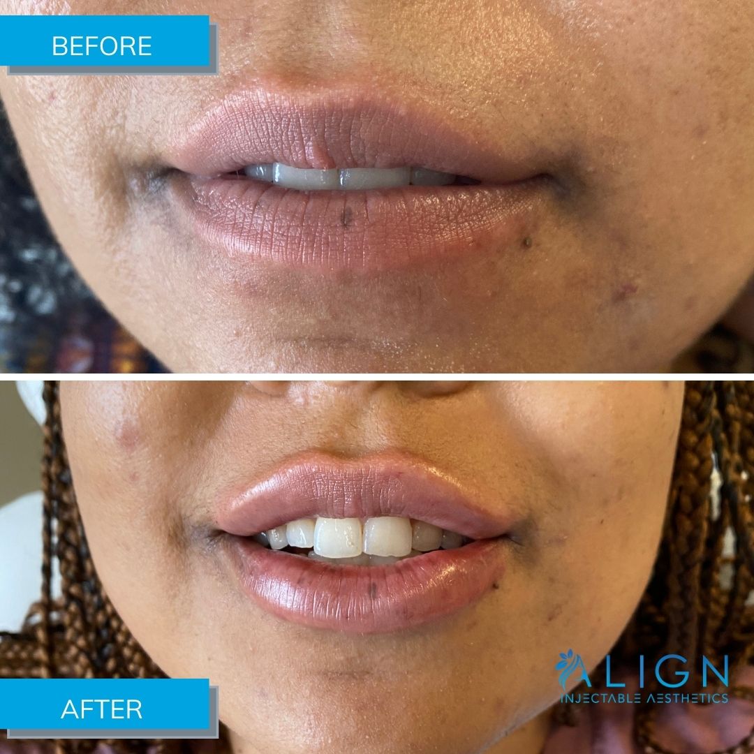 Before and After Lip Filler