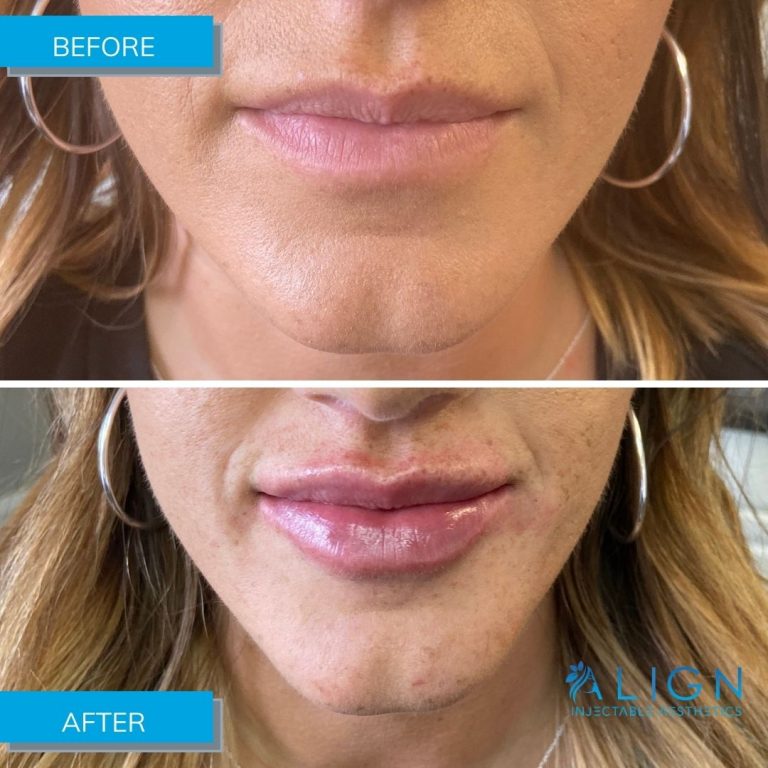 Cheap lip injections near me