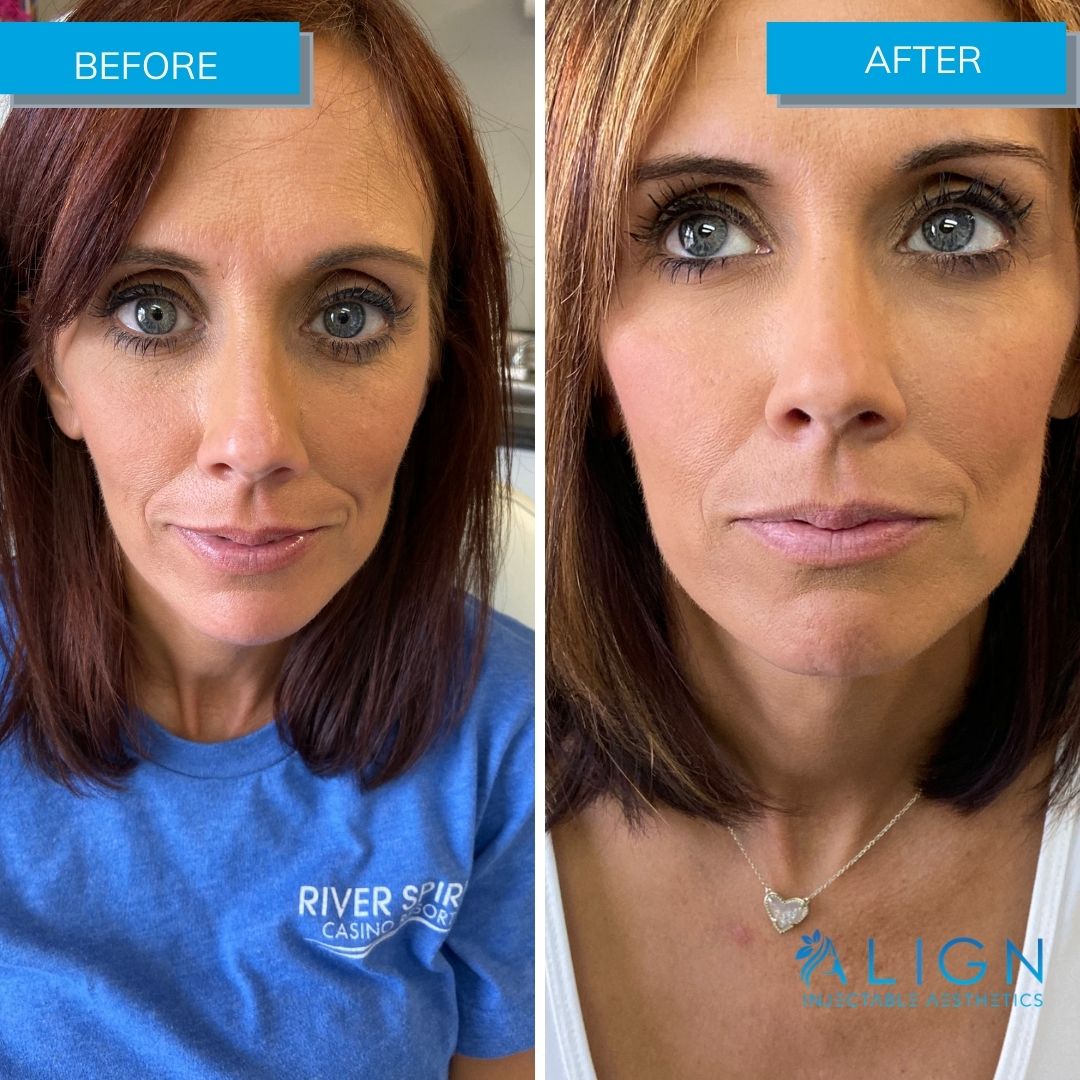 Before and after of woman at Tulsa medspa getting cheek filler to enhance face