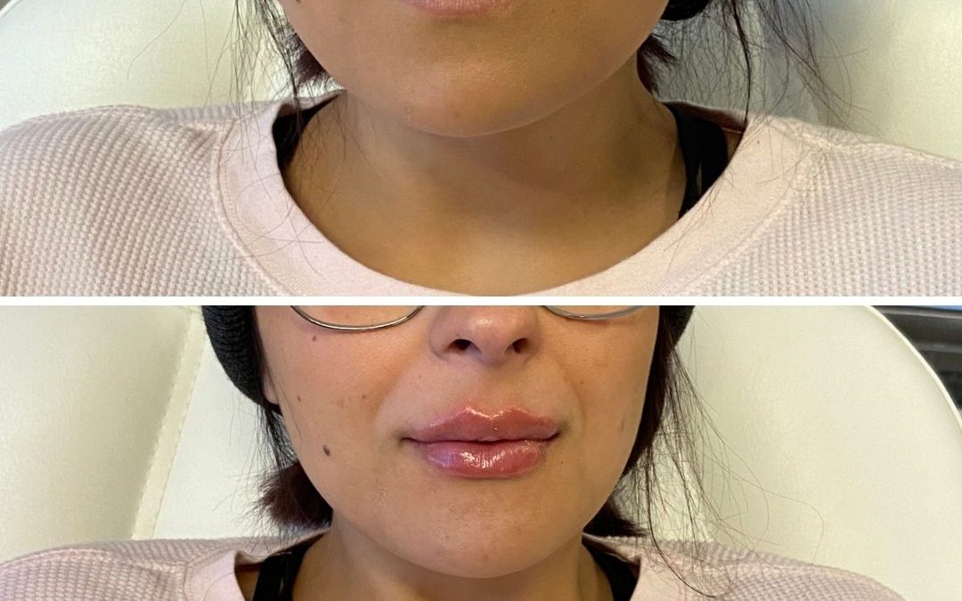 Before And After Lip Injections Tulsa Align Injectable Aesthetics