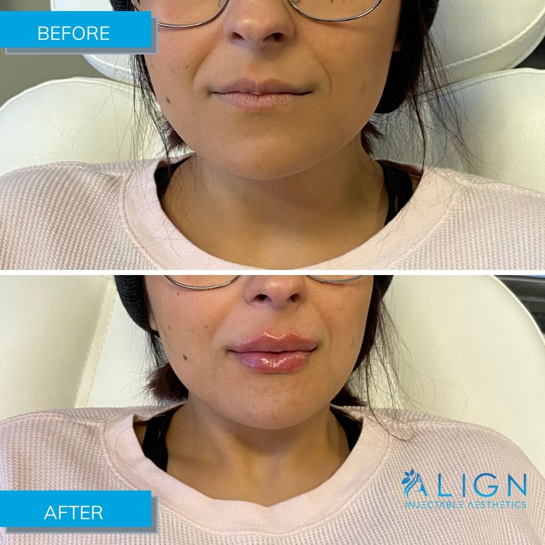 Before and after young woman gets lip injections at Align in Tulsa