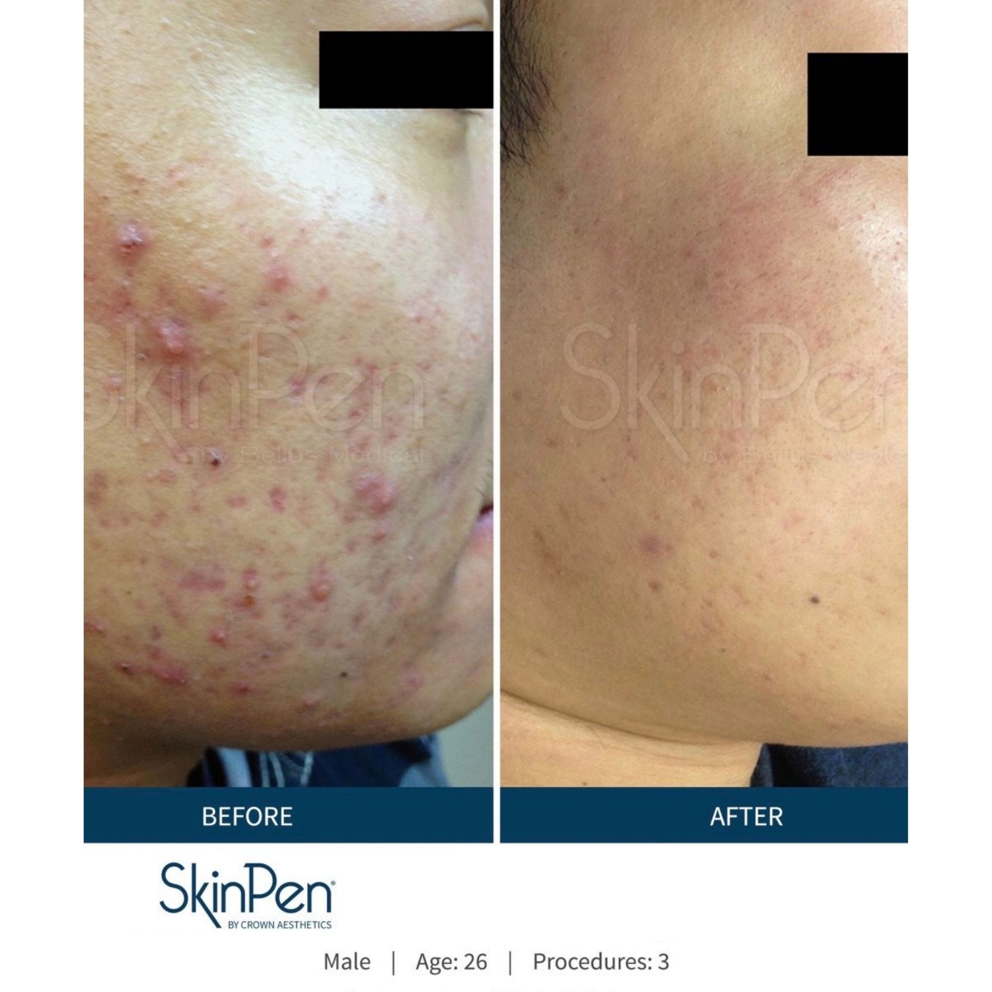 Improved acne and scaring on cheeks with skinpen