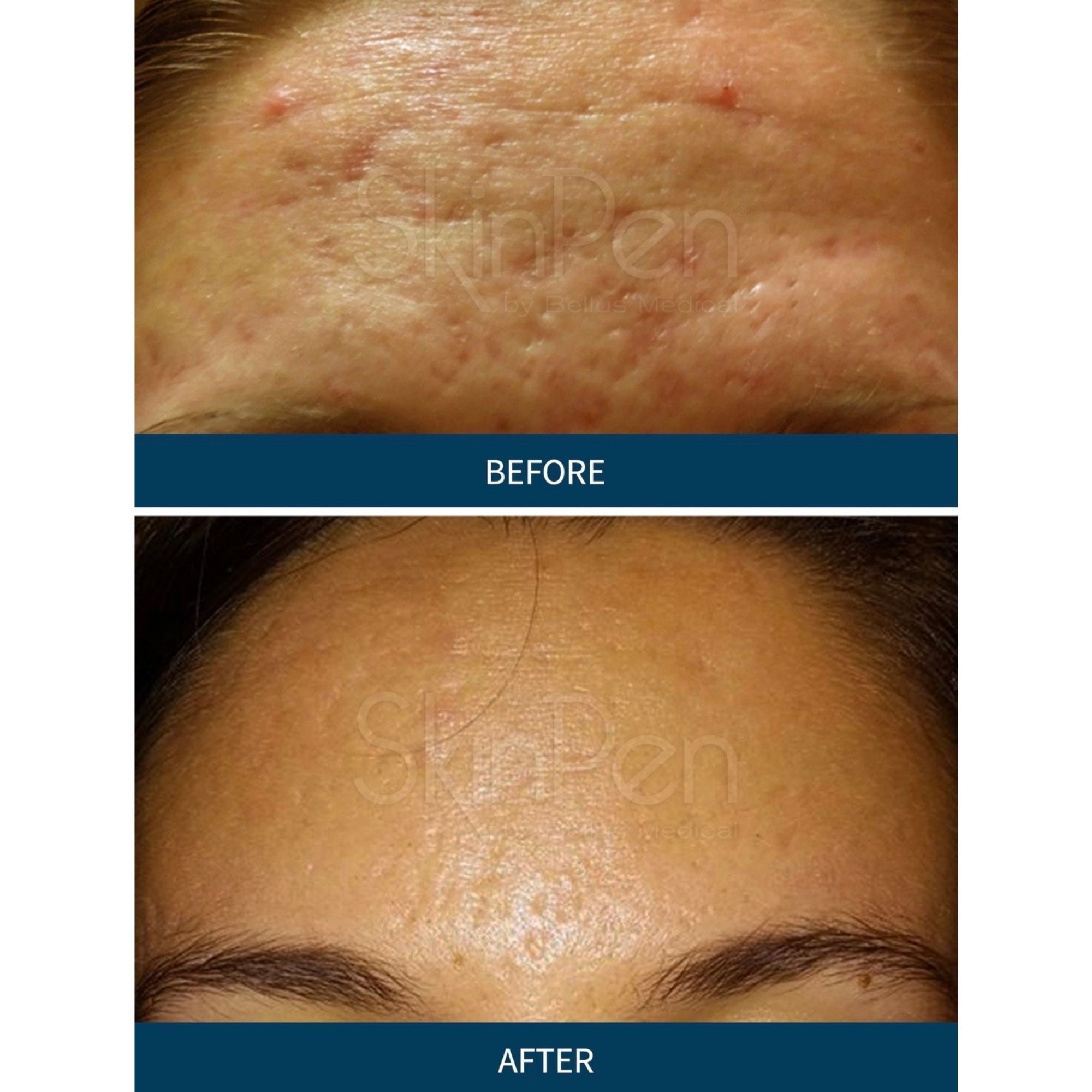 Young woman with improved acne scaring and breakouts from skinpen