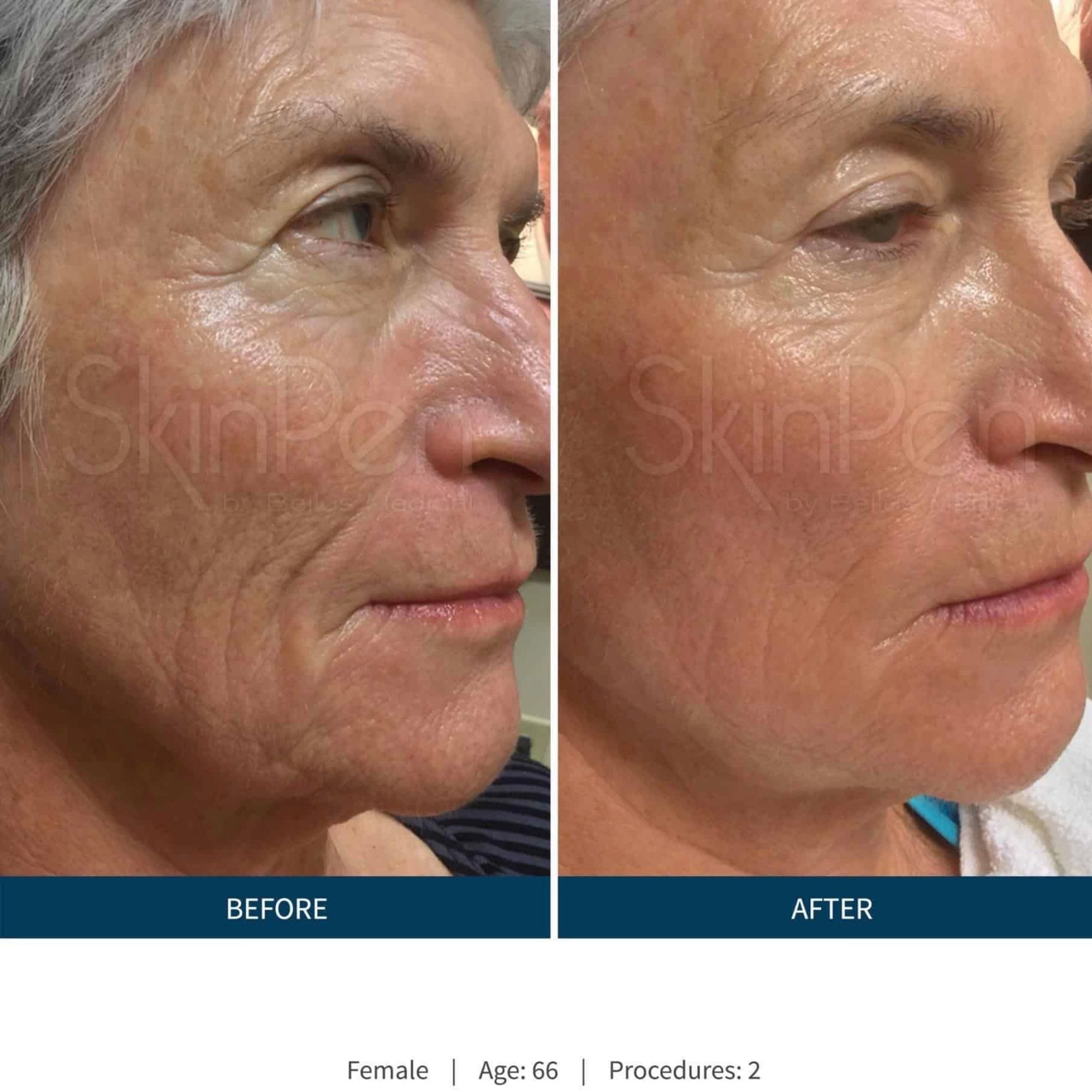 Mature woman that improved the appearance of wrinkles around her mouth with skinpen