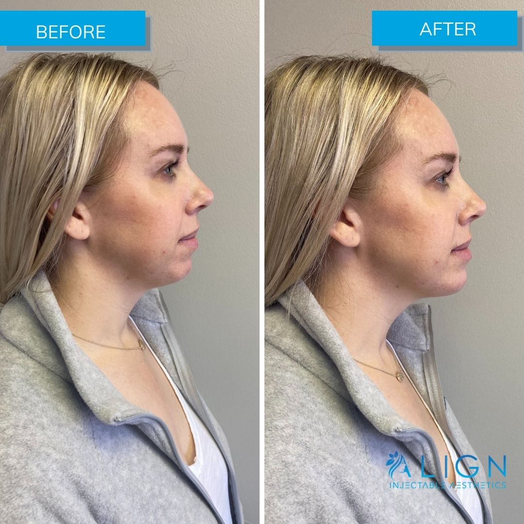 Before and After Chin Filler | Align Injectable Aesthetics