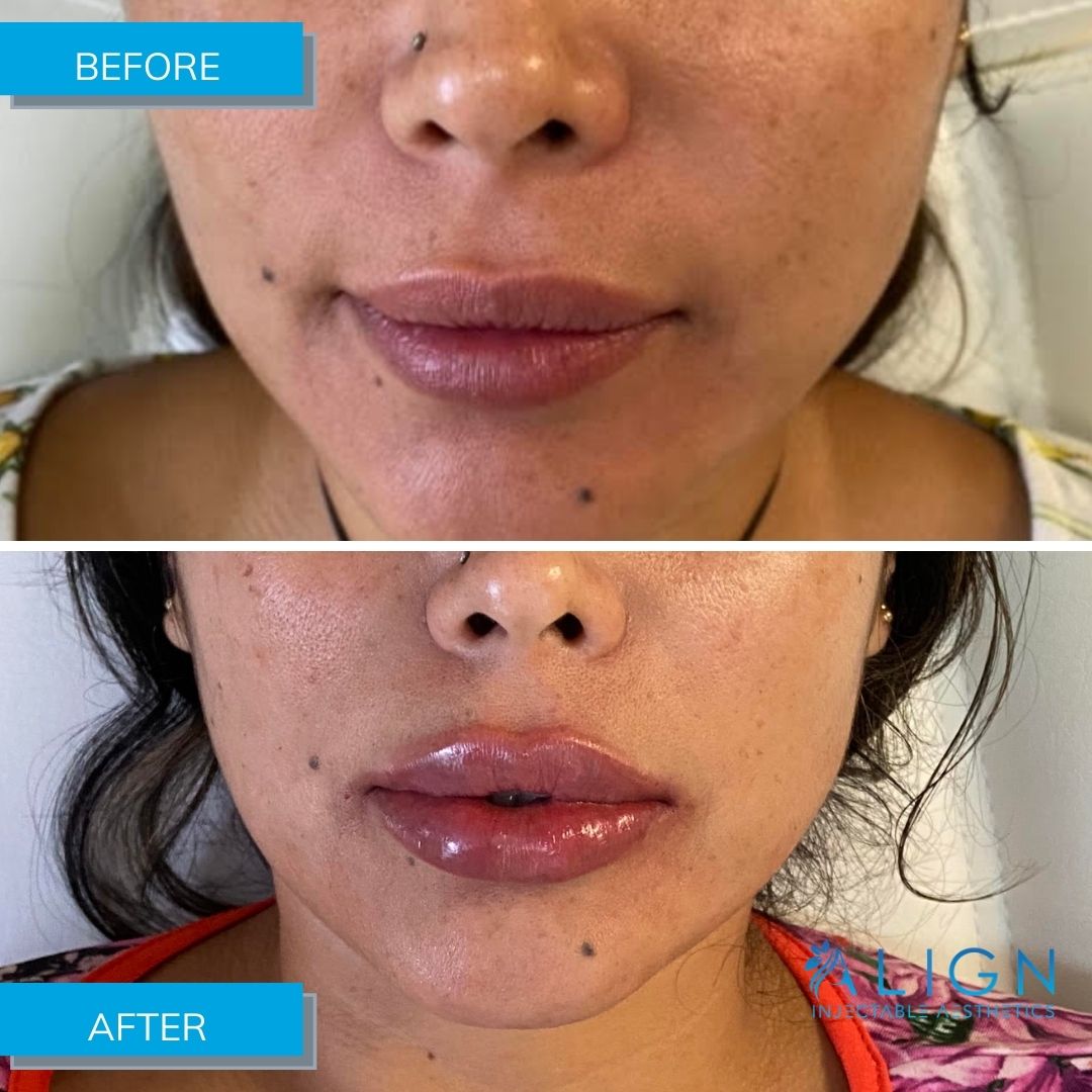 Lips by Align - Before and After Filler