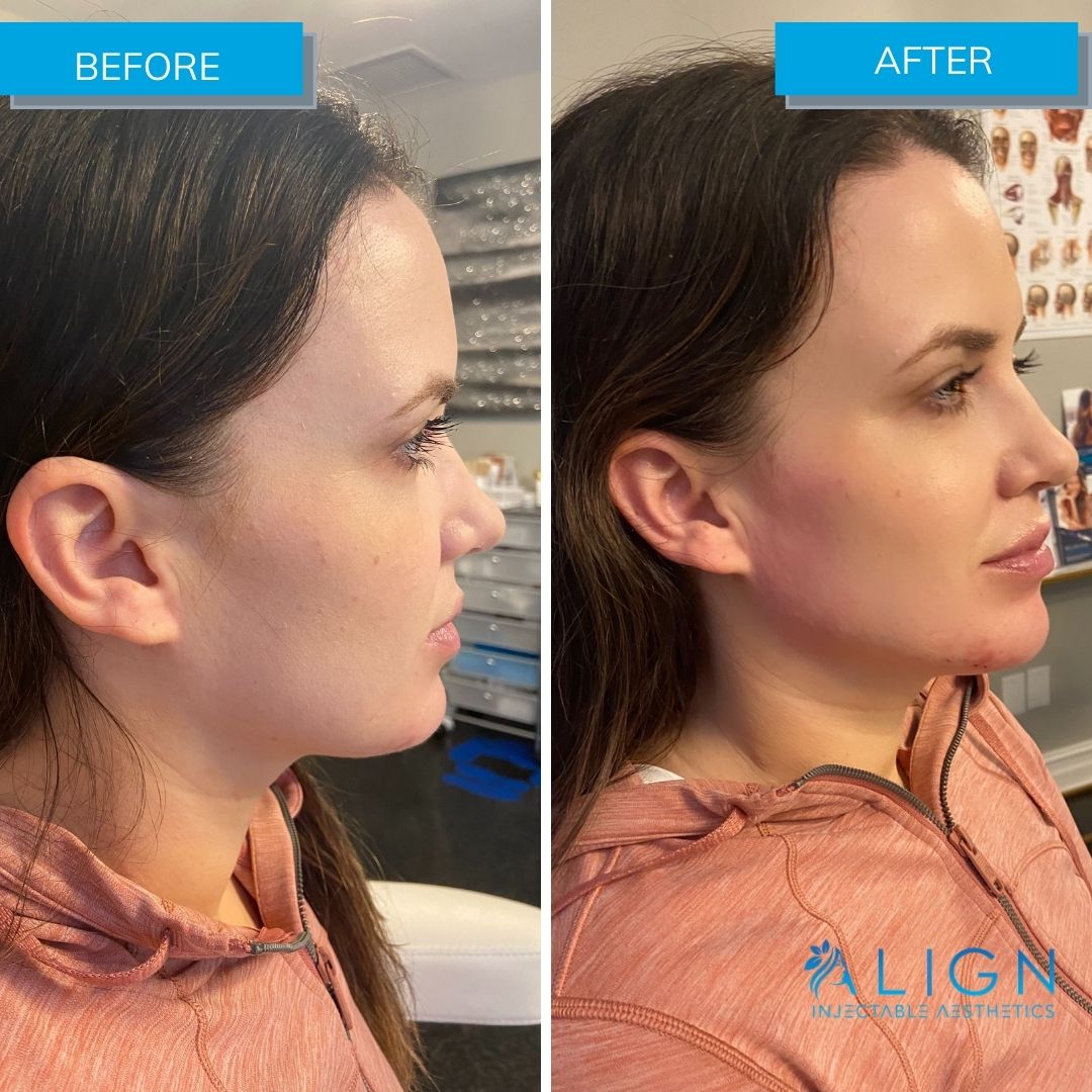 Young woman with enhanced jawline after injections