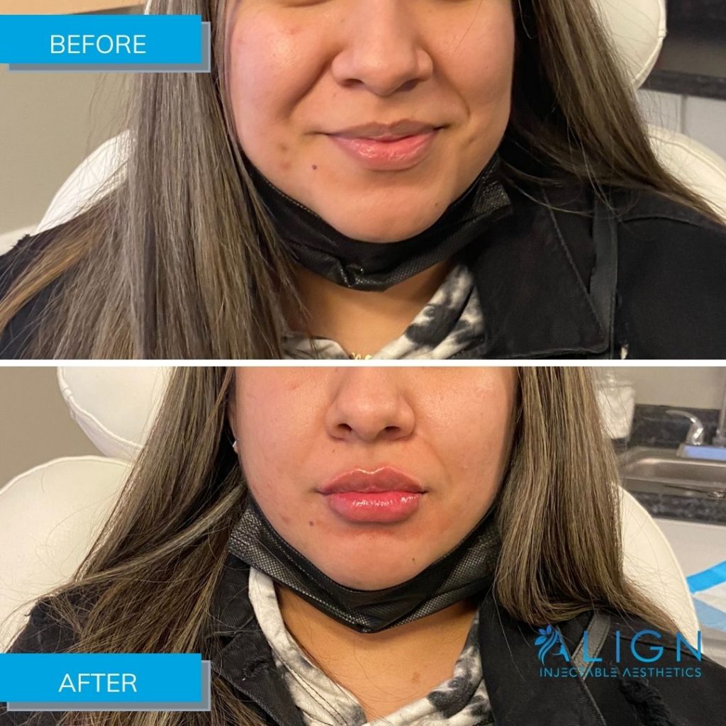 Frontal View Of Before After Lip Injections Align Injectable Aesthetics