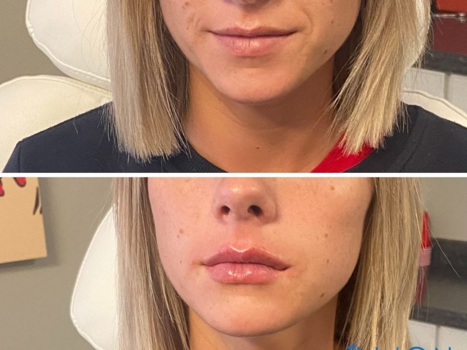 Before And After Lip Injections Tulsa Align Injectable Aesthetics