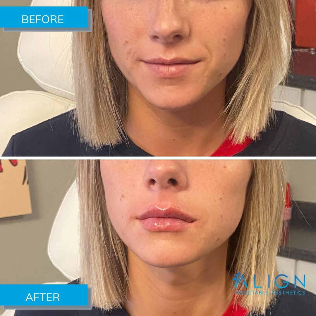 Young woman enhancing her lips using filler from Align
