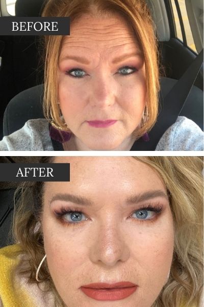 Before and after contouring with botox and filler