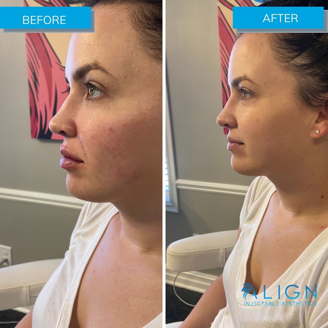 Before and After Cheek Filler at Align