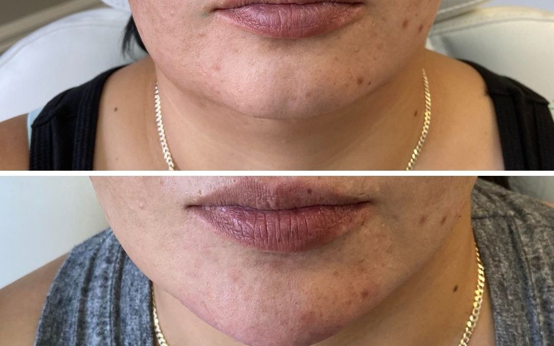Before and After Chin Filler at Align