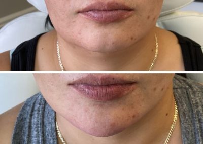 Before and After Chin Filler at Align