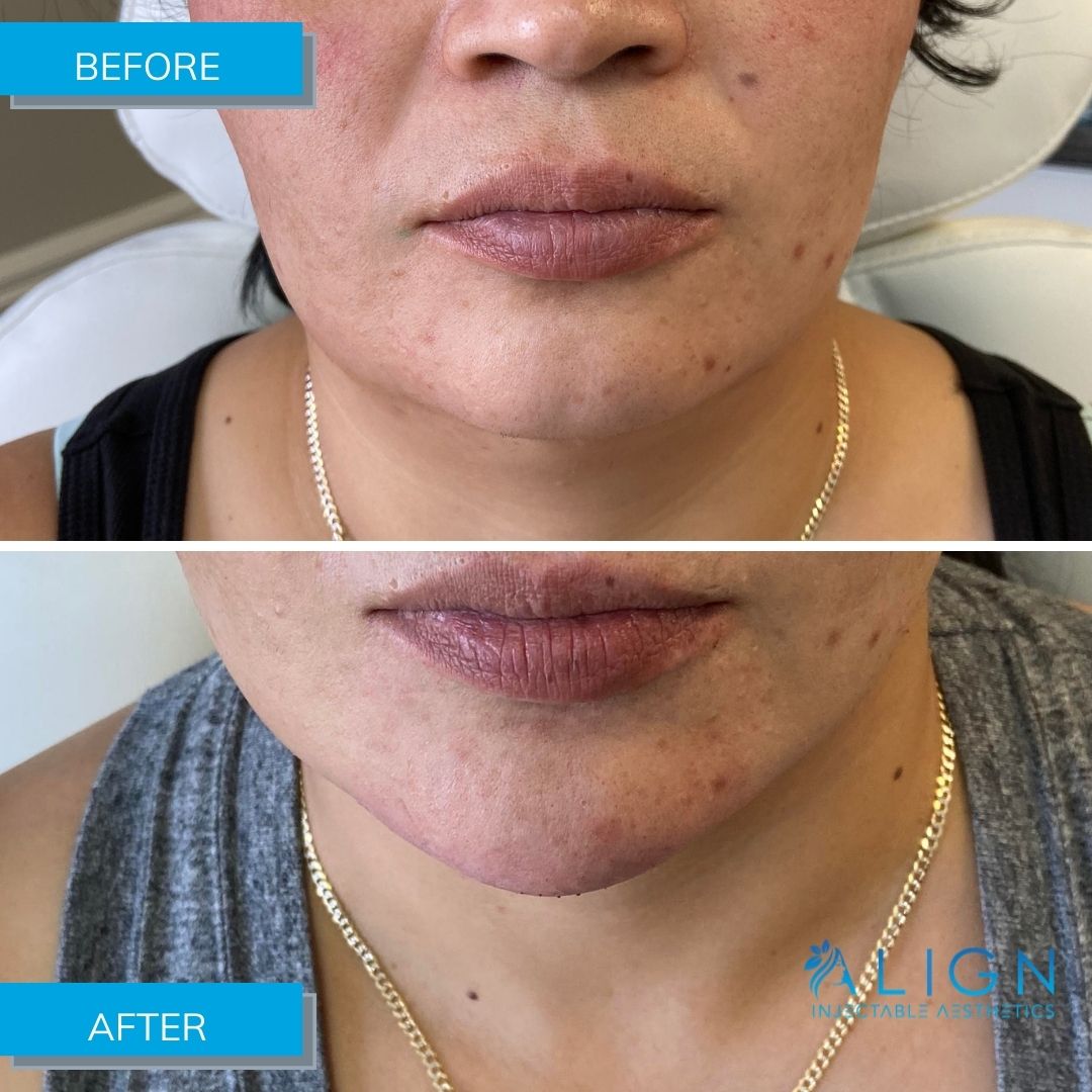 Before and After Chin Filler at Align