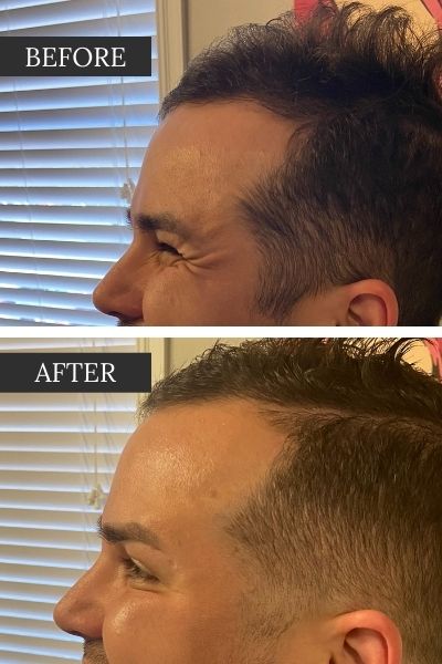 Before and After Dysport for Crows Feet