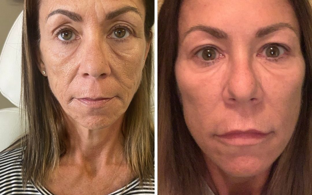 Before and After Xeomin® Injections