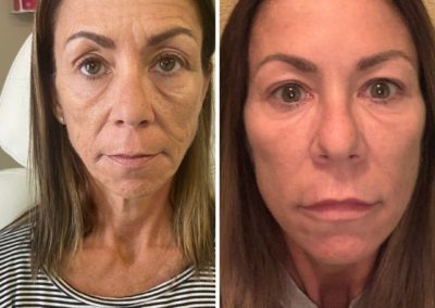 Before and After Xeomin® Injections