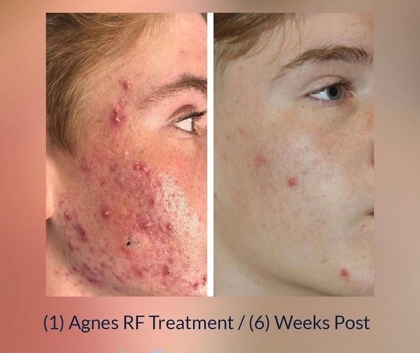 acne treatments in Tulsa before and after Agnes RF acne treatment