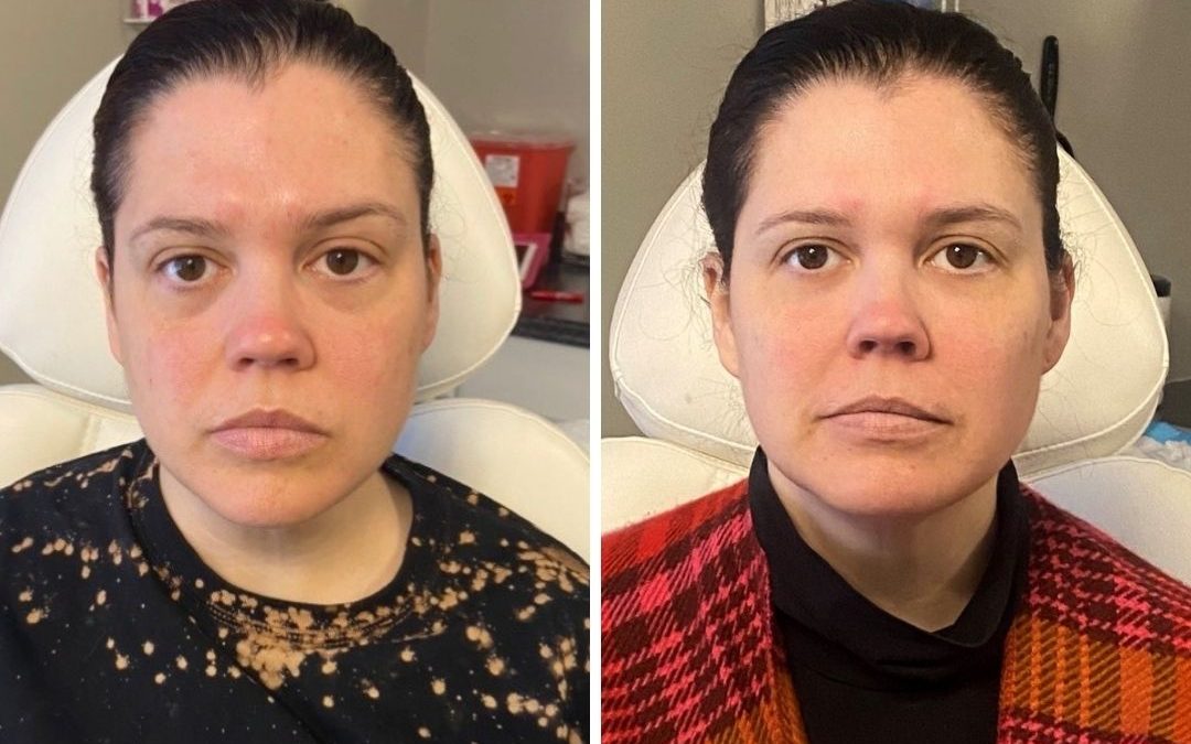 Before and After Cheek Filler