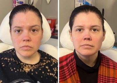 Before and After Cheek Filler