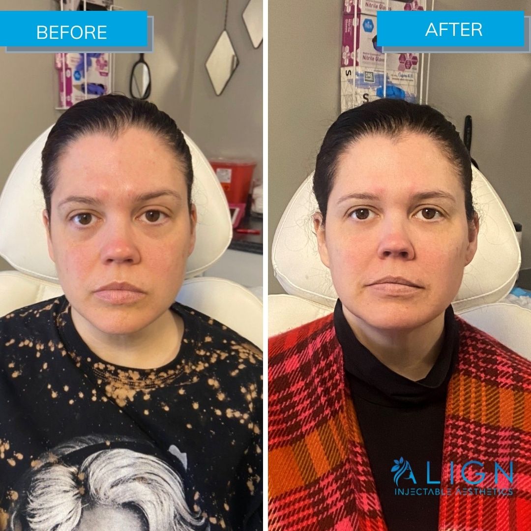 Before and after cheek filler at Align Injectable Aesthetics