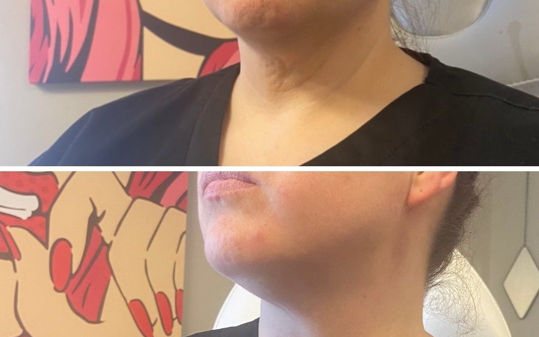 Before and After Non-Surgical Neck Treatment