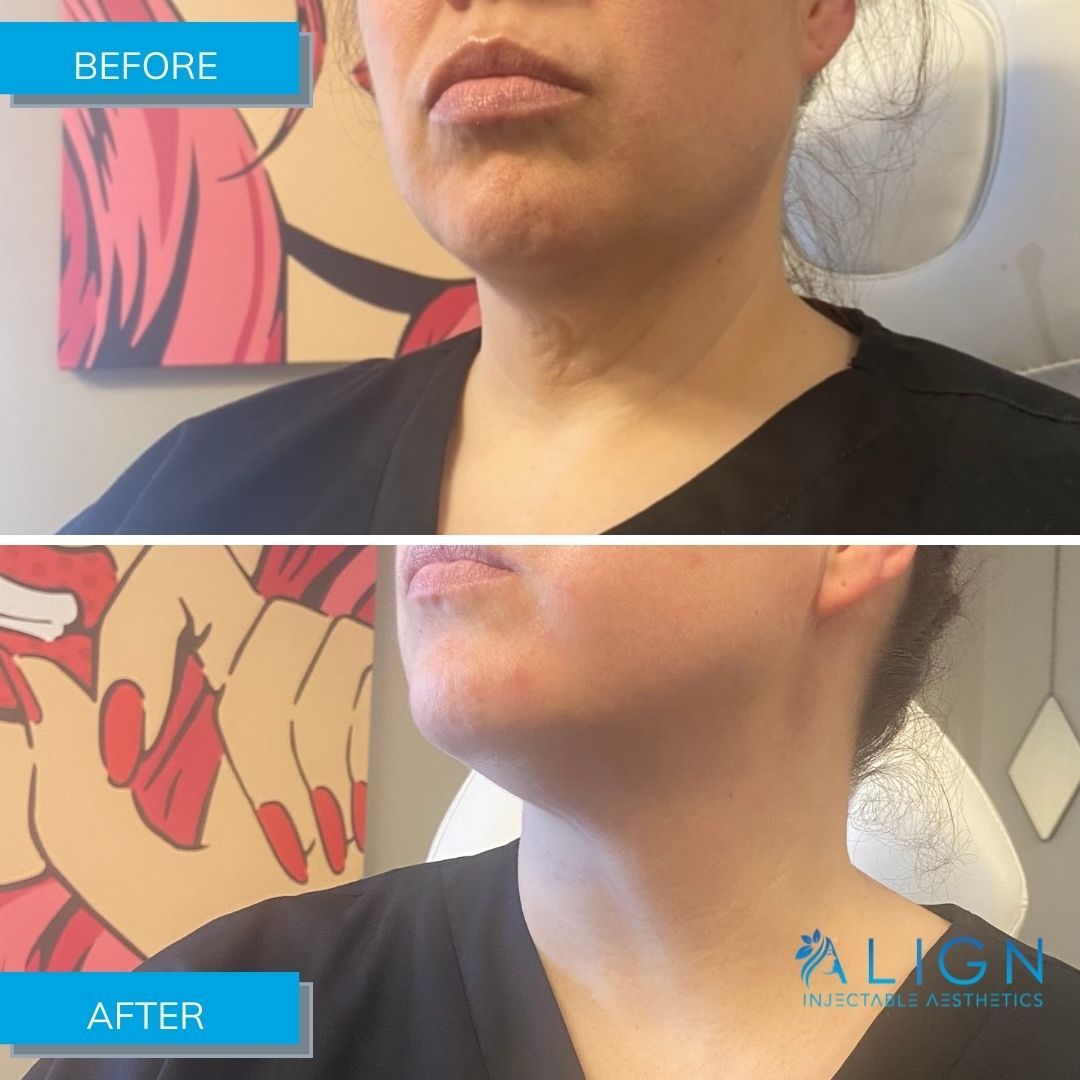 Before and After Neck Treatment