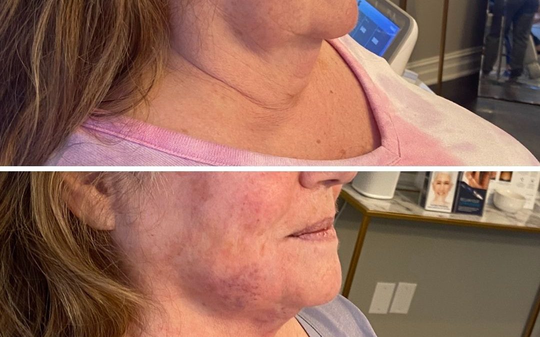 Before and After Agnes RF for Double Chin