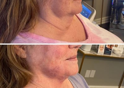 Before and After Agnes RF for Double Chin