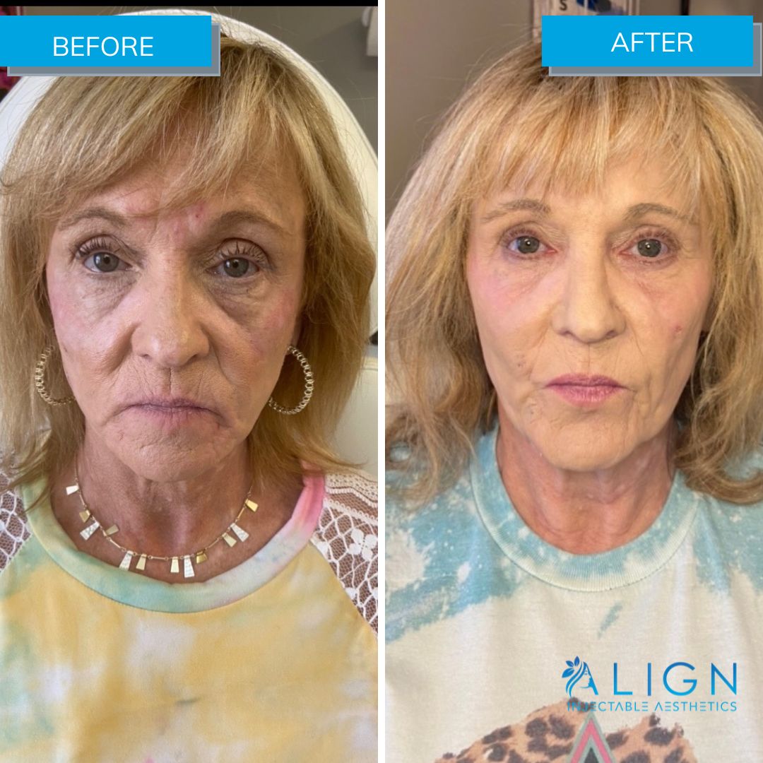 Under eye bag removal with Agnes RF Align Injectable Aesthetics