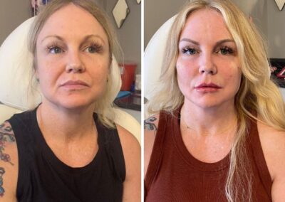 Before and After Cheek Filler at Align Injectable Aesthetics